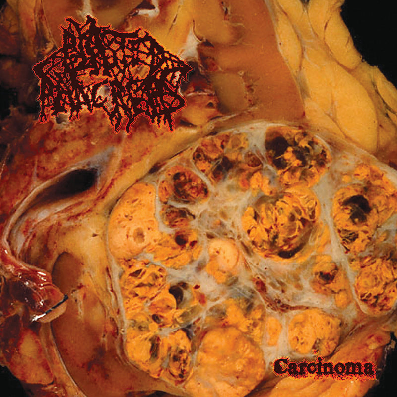 Blasted Pancreas "Carcinoma" CD